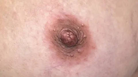 Tanya Buxton A 3D nipple tattoo which looks very realistic on someone's breast following a masectomy.