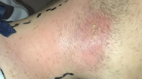 From Geraint Mullins A picture of the large abscess on his neck, which looks like a large red rash.