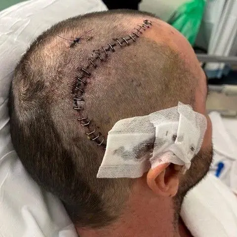 Adam Chapman The side of a man's head, which has been shaved There is a large scar that is still healing running along the side of his head, it has lots of staples in it. Above the man's ear there are dressings attached