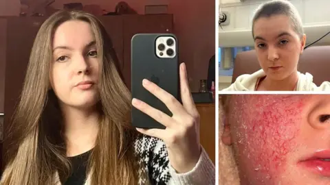 Bethany Gamble Three photos of Bethany. In the first pic she is holding her phone to take a selfie. She looks healthy and her skin is clear. In the top right pic she has shaved her hair off, in the bottom right pic her cheek skin is bright red and peeling