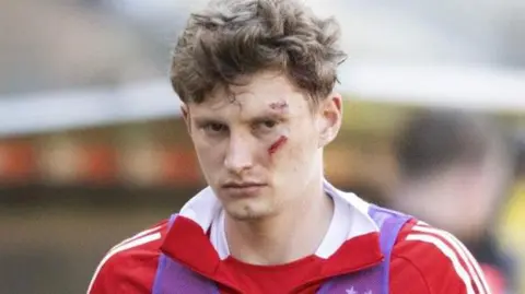 Aberdeen footballer Jack McKenzie with injured face.