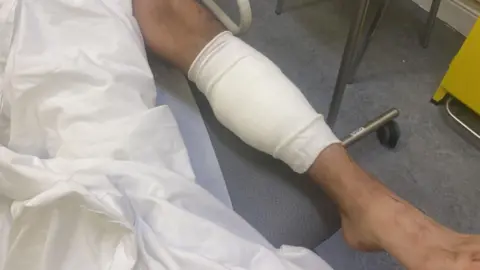 Paul Byrne A bandaged leg on a bed, a blanket is over the other leg