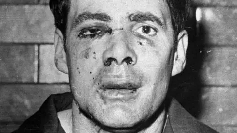 PA Media A black and white photograph taken of Donald Neilson. He has a wall behind him, he is staring at the camera and he has an injury to his eye, cuts to his right cheek and lips.