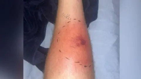 Daniel Hendron A red patch on his leg. Above it on the image is a date written on the leg.