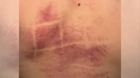 Contributed A close up of pink/purple bruising on a young boy's back