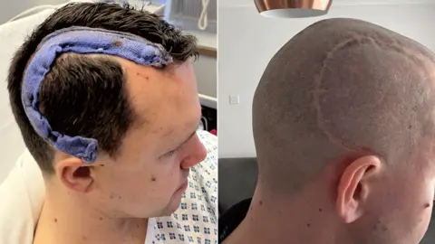 Two profile shots of Charlie post-operation. One shows blue bandaging covering his scar as he sits in his hospital bed, the second shows his head completely shaved, the healing scar a C-shape from the front of his head to the top of his ear.