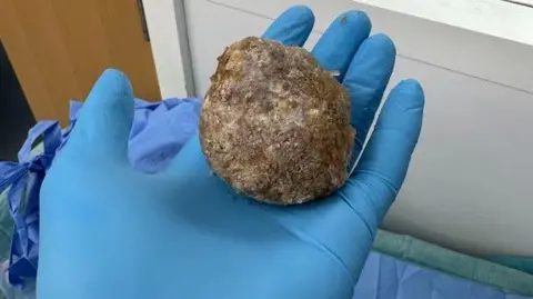 Viliam Hoferica A bladder stone