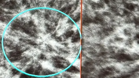 Newcastle Hospitals This is a very close black and white image of a breast cancer tumour. It has a small green circle to point it out.