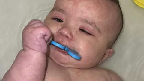 Morgan Birch Uma foto de Kimie com uma erupção vermelha visível em seu corpo, um sintoma comum de sarampo.