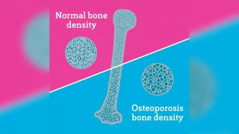 Diagram of a human bone and bone cells