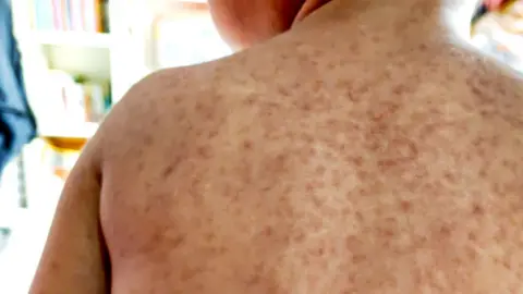 A child's back with a rash symptomatic of measles