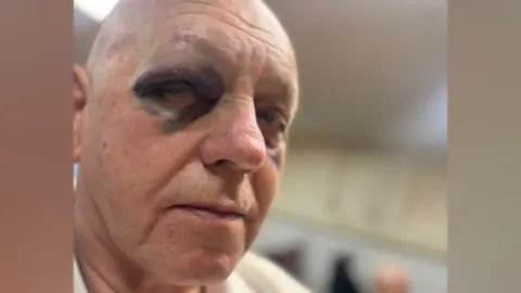 A close-up photo showing James Bentley. Bentley is clean-shaven with a bald head; he has deep purple and black bruising around his eyes. He is looking into the camera with a serious expression. 