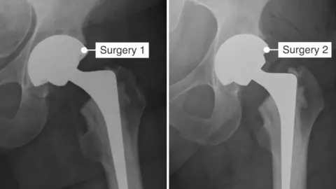 Mandy Dossett Two X-rays are side by side. They both show the results of hip replacement surgery. The first on the left was taken after the incorrect component was implanted into the patient, the second on the right shows the correct component. The first looks to be more at an angle than the second X-ray, with the components looking more misaligned than the second. 