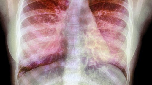 X-ray showing a build up of mucus in a patient's lungs