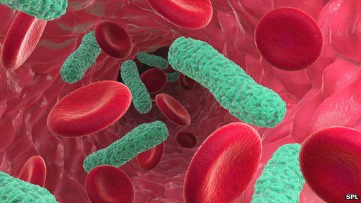 Bacterial infection of the blood causing sepsis