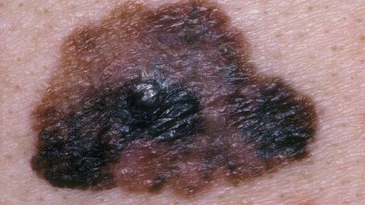 Melanoma or serious skin cancer