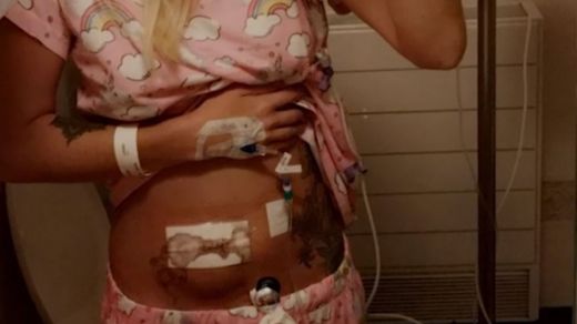 Imagen del vientre de Hannah tras la operación.
