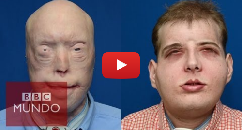 Publicación de Youtube por BBC News Mundo: El trasplante de cara más completo de la historia