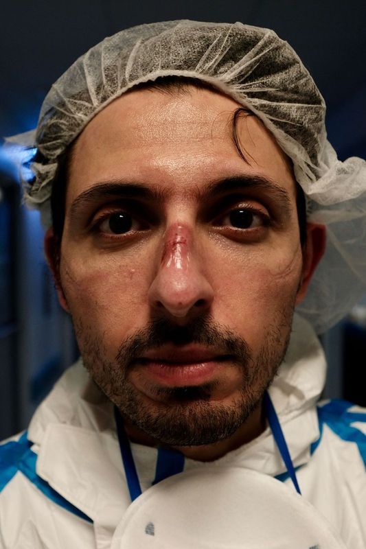A male nurse with wounds on his nose and cheeks caused by protective equipment