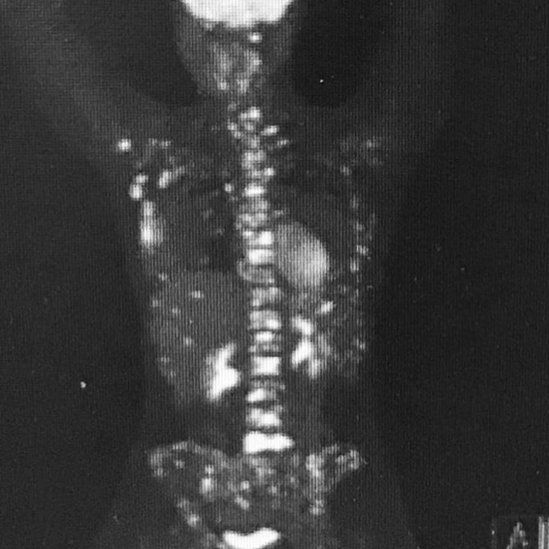 An X-ray of Nicky Newman's body
