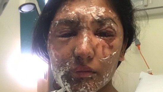 Resham Khan with facial burns