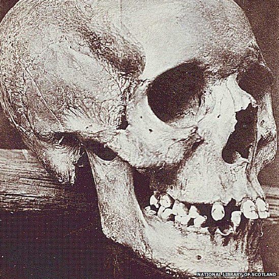 The skull from the grave was displayed at St Andrews University Museum