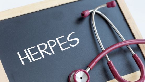 Pizarra que dice "herpes"