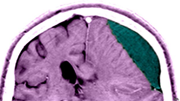 ¿Qué tan peligroso es un golpe en la cabeza? - BBC News Mundo