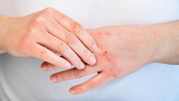 Close em par de mãos com machucados provenientes de alergia