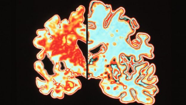 Cerebro con enfermedad de Alzheimer, a la izquierda, comparado con un cerebro sano, a la derecha.