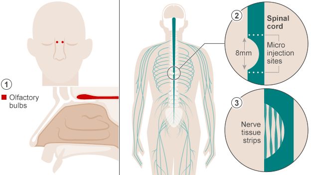 Spinal graphic