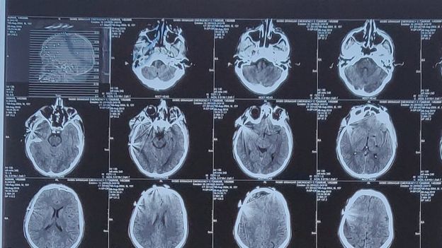 A photo of an X-ray of Asrar's skull, with pellets visible in the top left hand corner of the scan