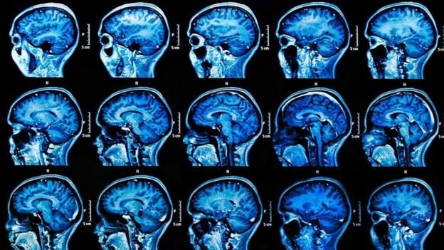 ImÃ¡genes de escÃ¡ner cerebral