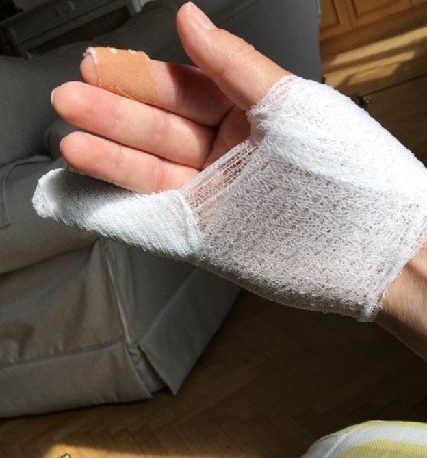 தன் கையில் உள்ள காயத்தை காண்பிக்கிறார் டர்னர்