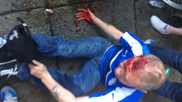 Injured Leicester City Fan