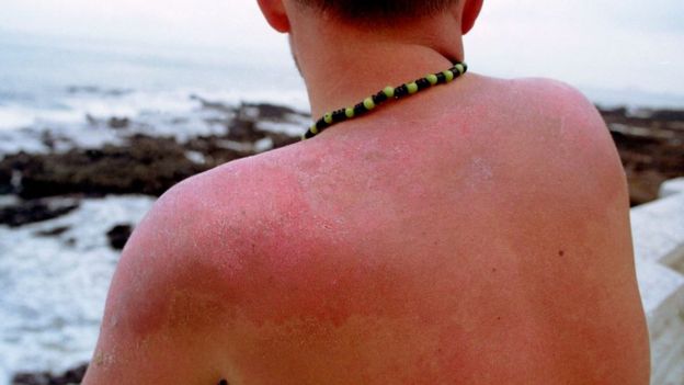 رجل يعاني حروقا شمسية في البرازيل