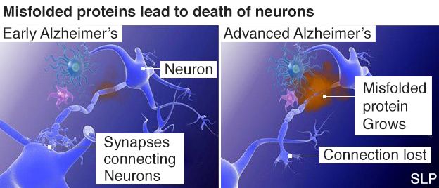 Infographic showing difference between early and advanced Alzheimer's disease