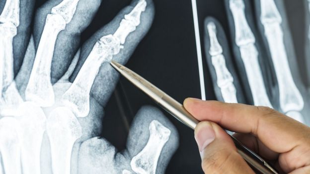 Caneta aponta para dedo fraturado em imagem de raio X