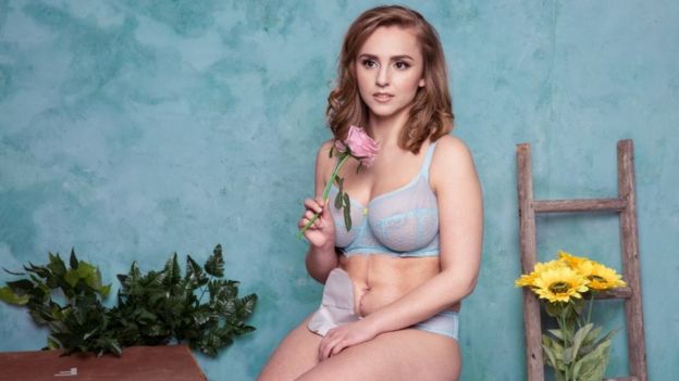 Hannah Witton en ropa interior enseñando su estoma.