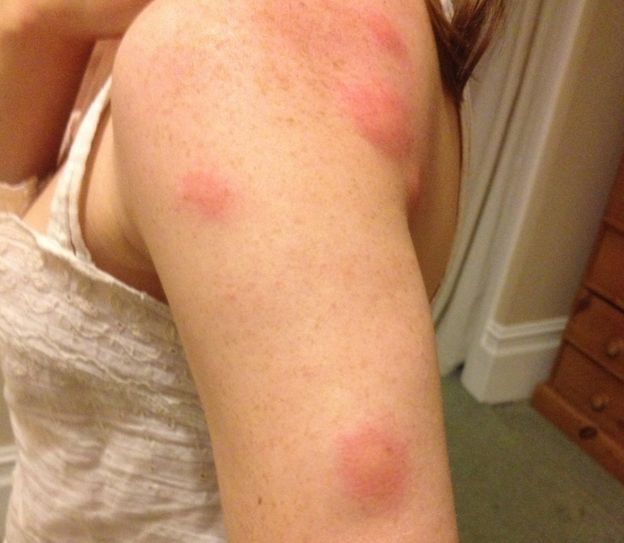 Bed Bug Allergic Reaction