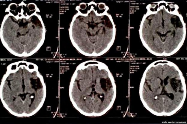 Danos no cérebro de um paciente com a síndrome