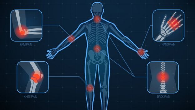 Gráfico que muestra las articulaciones del cuerpo más afectadas por la artritis