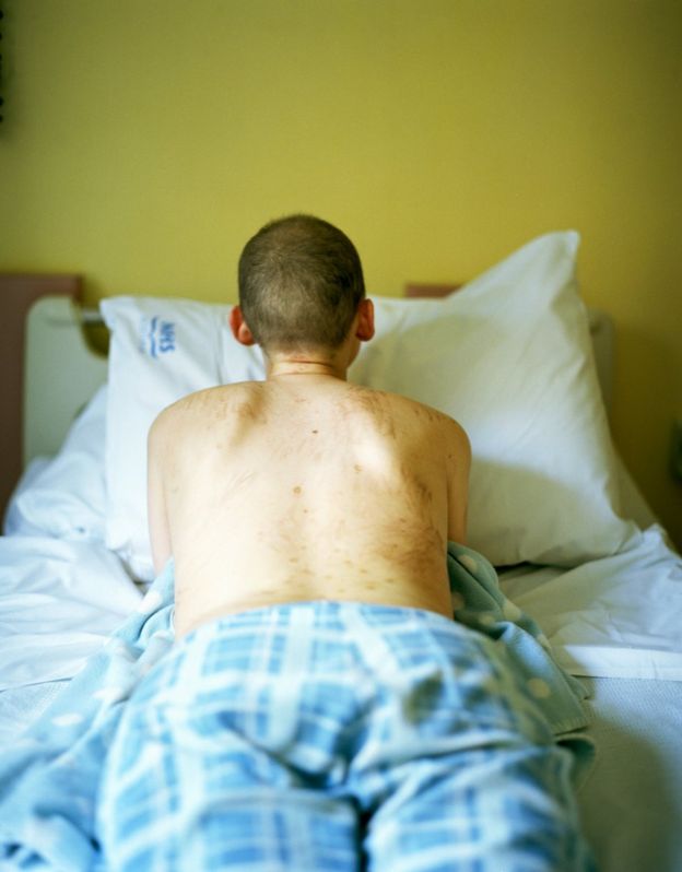 Carly Clarke lies on a hospital bed, displaying blemishes on her back resulting from treatment