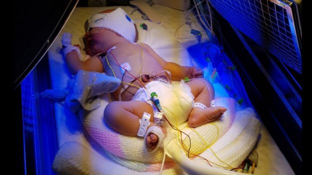 Un babé recién nacido recibiendo una transfusión.