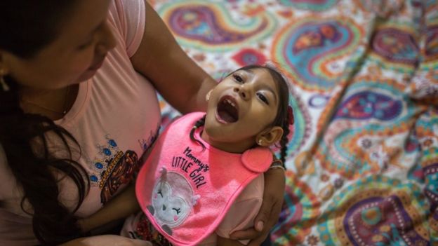 Paciente con hidrocefalia en Brasil como consecuencia del zika