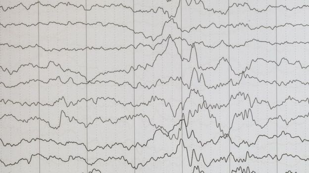 Encefalograma epilepsia.