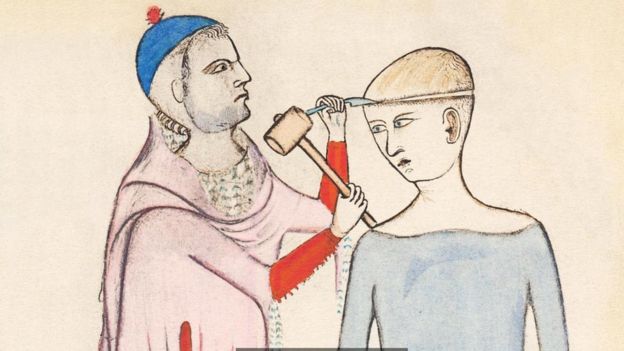 Una pintura sobre una trepanacin que data del siglo XIV autora de Guido da Vigevano
