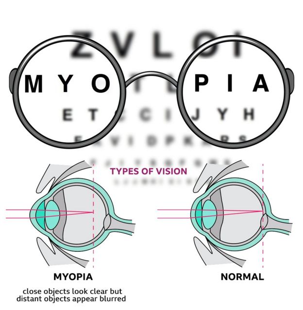 Image result for myopia pinterest