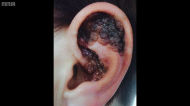Ухо, покрытое черной опухолью