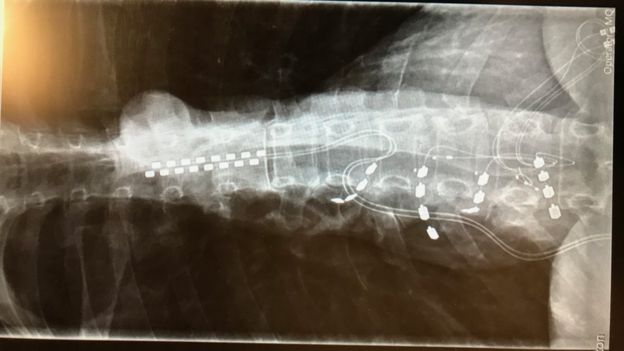 X Ray of the implants in Alison Cameron